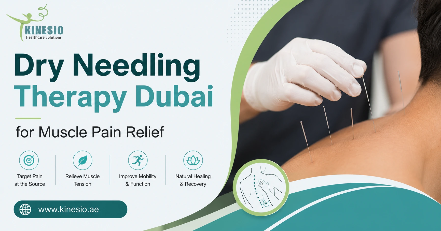 Professional dry needling therapy Dubai helping relieve muscle pain, improve mobility, and support faster recovery with expert care.